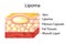 Lipoma are adipose tumors located in the subcutaneous tissues.