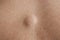 Lipoma close up shot on the back of a caucasian man