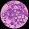 Lipoma on cubital fossa, benign growth of fatty tissue, benign neoplasm, adipocytes, partially capsulated tumor.