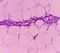 Lipoma on cubital fossa, benign growth of fatty tissue, benign neoplasm, adipocytes, partially capsulated tumor, 40x microscopic v