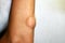 Lipoma on the elbow of the arm