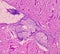 Lipoma on loin, benign growth of fatty tissue, benign neoplasm, adipocytes, partially capsulated tumor.