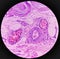 Lipoma on loin, benign growth of fatty tissue, benign neoplasm, adipocytes, partially capsulated tumor,.