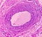 Lipoma on loin, benign growth of fatty tissue, benign neoplasm, adipocytes, partially capsulated tumor