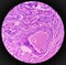 Lipoma on loin, benign growth of fatty tissue, benign neoplasm, adipocytes, partially capsulated tumor,