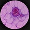 Lipoma on loin, benign growth of fatty tissue, benign neoplasm, adipocytes, partially capsulated tumor,