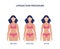 Liposuction procedure before and after banner flat vector illustration isolated.