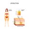 Liposuction process and areas for lipo