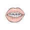 lips braces illustration. Erotic playful hot clipart. Modern smile fashion illustration. Pop art open mouth with teeth and de