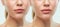 Before and after lips filler injections. Beauty plastic. Beautiful perfect lips with natural makeup.