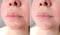 Lips, mouth and chin of a middle-aged woman, part of the face close-up, fine wrinkles on the face, before and after lip