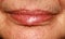 Lips. Silicone. Nasolabial folds. Wrinkles around the mouth