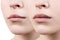 Lips of young woman before and after augmentation.