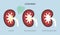 Lithotripsy procedure concept