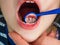 Little girl at the dentist examining a lose tooth with mirror