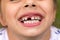 Little girl fell a baby tooth. Child\'s mouth with hole between the teeth