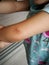 Little girl has allergies with mosquitoes bite and itching her skin. Mosquito blood breeding on kids.Repellent, Dengue virus,