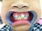A little girl with heavy cross bite condition which is a type of oral misalignment is showing her teeth to the dentist. Pranburi,