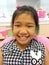 A little girl with heavy cross bite condition which is a type of oral misalignment is showing her teeth to the dentist. Pranburi,