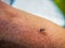 Little mosquito bitting human`s skin