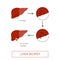 Liver biopsy