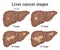 Liver cancer stages