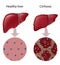 Liver Cirrhosis