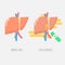 liver cirrhosis with drinking alcohol