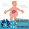 Liver Cirrhosis. infographic -