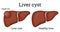 Liver cyst illustration