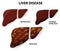 Liver Disease