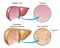 Liver with hereditary hemochromatosis