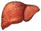 Liver patients with hepatitis. Liver is sick person. Cirrhosis of liver. Repercussion alcoholism