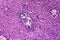 Liver schistosomiasis, light micrograph