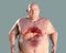 Liver steatosis in obese man, fatty liver