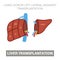 Liver transplantation concept