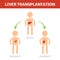 Liver transplantation concept