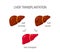 Liver transplantation vector concept