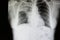 a lobar pneumonia