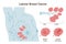 Lobular carcinoma. Detailed breast medical anatomy. Cross section