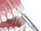 Local Dental anesthesia. 3D illustration of dental treatment