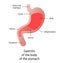 Location of Gastritis, body of it, an inflammation of the lining of the stomach. Three types Antral, of the body and pangastritis