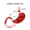 Location of peptic ulcer