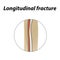 Longitudinal bone fracture. Infographics. Vector illustration on a lined background.