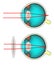 Longsighted human eye diagram