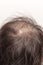 Lose one\'s hair glabrous baldy loss