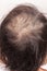 Lose one\'s hair glabrous baldy loss