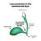 Low connection to the common bile duct. Pathology of the gallbladder. Cholecystitis.