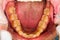 Lower Denture