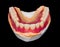 Lower denture